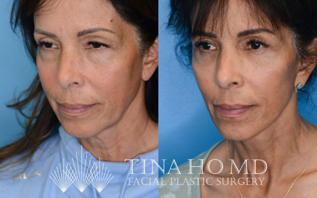 tina-ho-plastic-surgery (1)