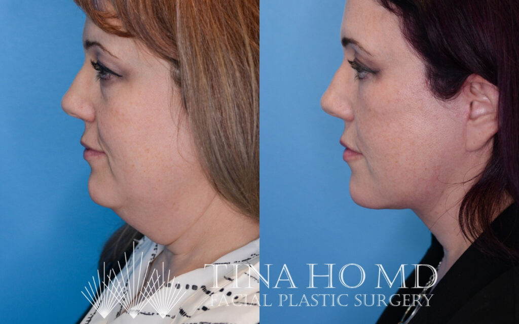 tina-ho-plastic-surgery (2)