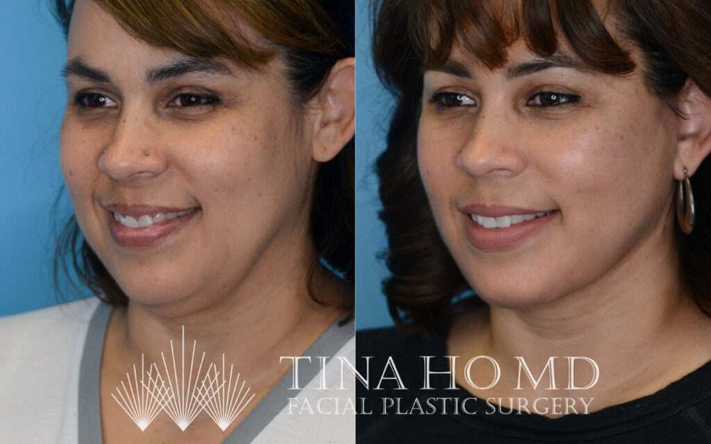 tina-ho-plastic-surgery (3)