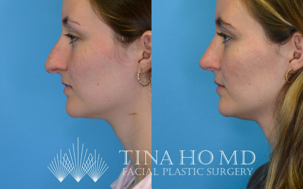 tina-ho-plastic-surgery (4)